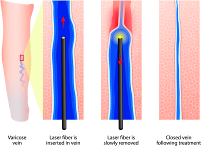 Minimally Invasive Vein Treatments