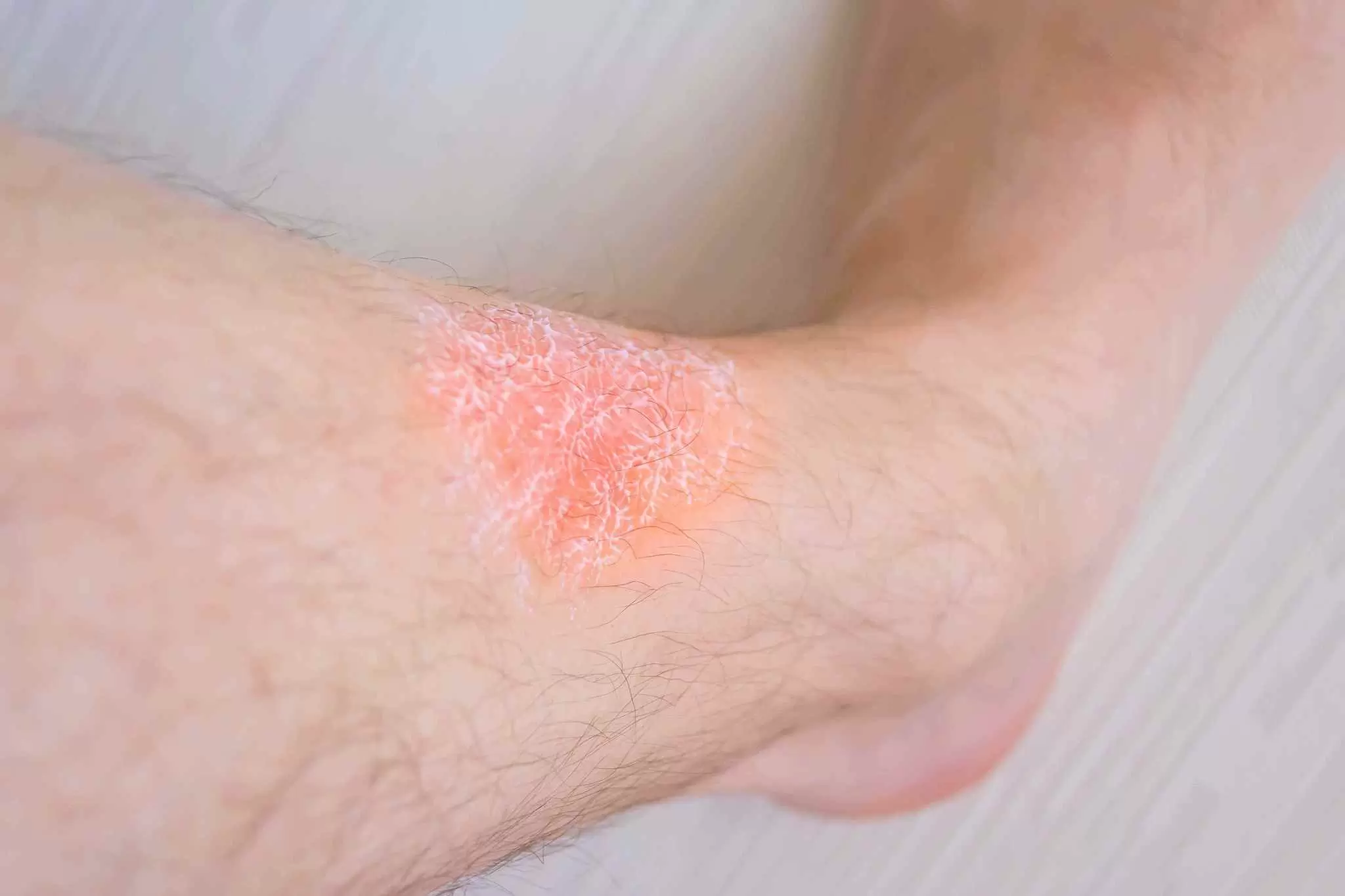 Stasis Dermatitis, Venous Eczema